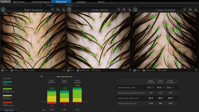 Canfield HairMetrix® konsultationsmjukvara