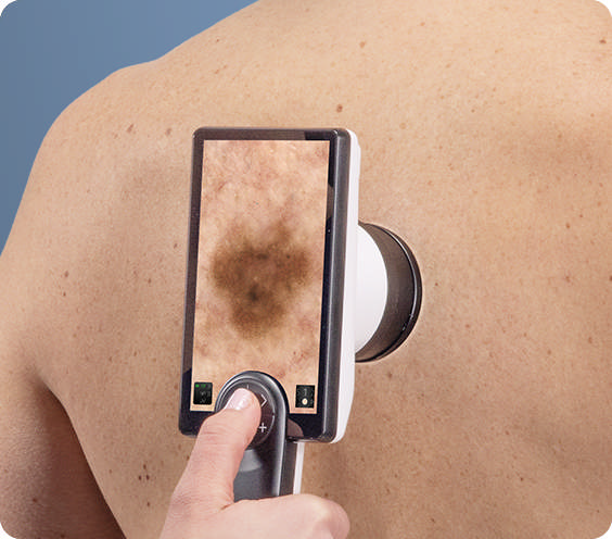 Canfield D2 dermatoskop